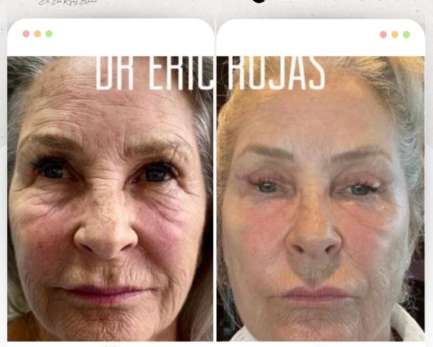 Rejuvenecimiento Facial, la mejor técnica del país.