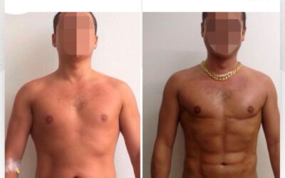 Mira los increíbles resultados del Slim Láser en nuestro paciente, ¿Qué te pareció el cambio?