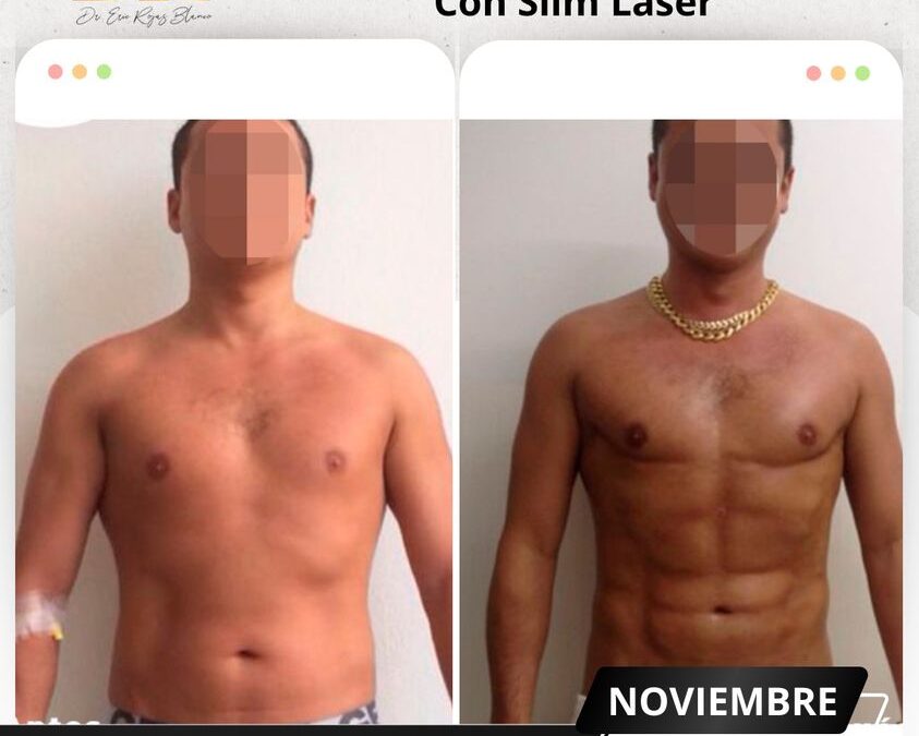 Mira los increíbles resultados del Slim Láser en nuestro paciente, ¿Qué te pareció el cambio?