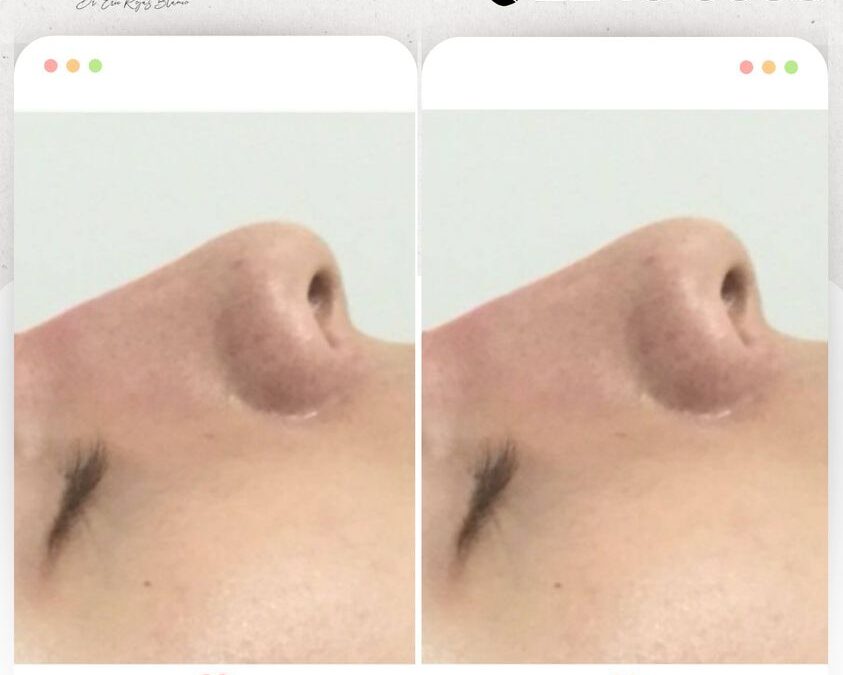 Rinolift es el procedimiento ideal para mejorar el perfil de tu nariz.