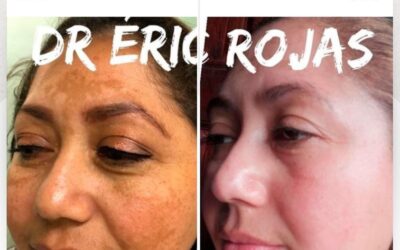 Si tienes manchas en el rostro puedes visitarnos y con todo el gusto te brindamos la solución. 🆒👇
