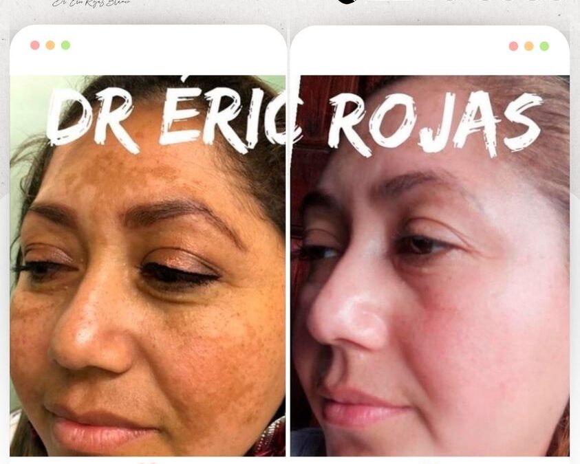Si tienes manchas en el rostro puedes visitarnos y con todo el gusto te brindamos la solución. 🆒👇