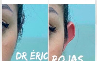Deja los complejos y corrige tus orejas con la dermo otoplastía