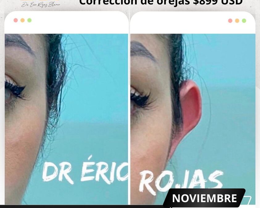 Deja los complejos y corrige tus orejas con la dermo otoplastía