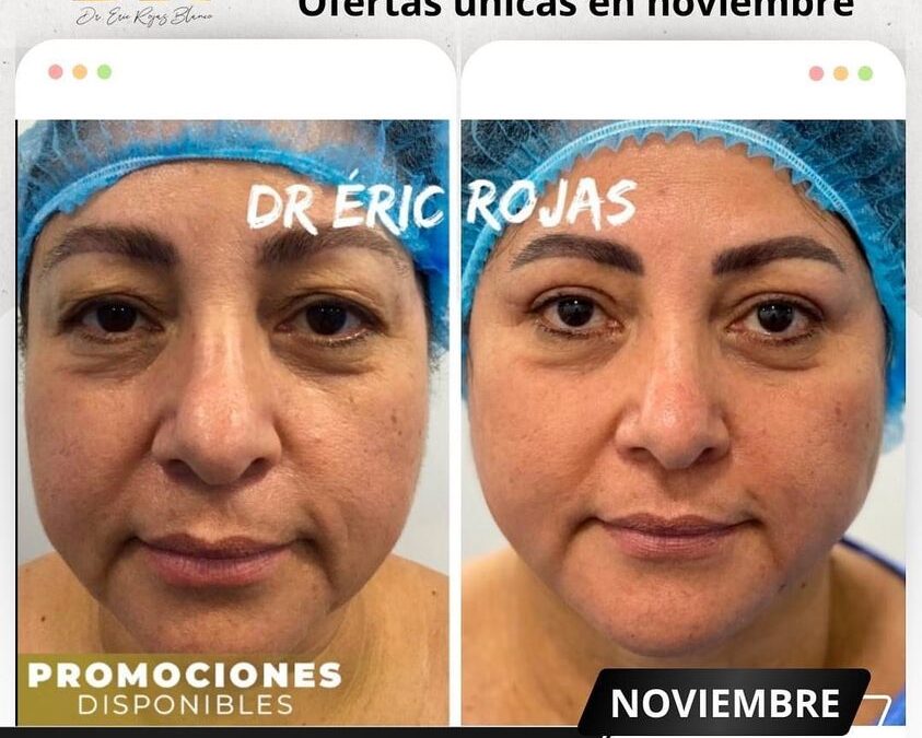 ¡Aún tienes tiempo!, aprovecha la oportunidad de realizarte un refrescamiento facial.