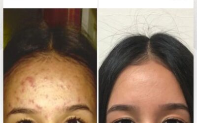 Mira el increíble cambio de nuestra paciente en su rostro, no dudes más y elimina el acné de tu vida.