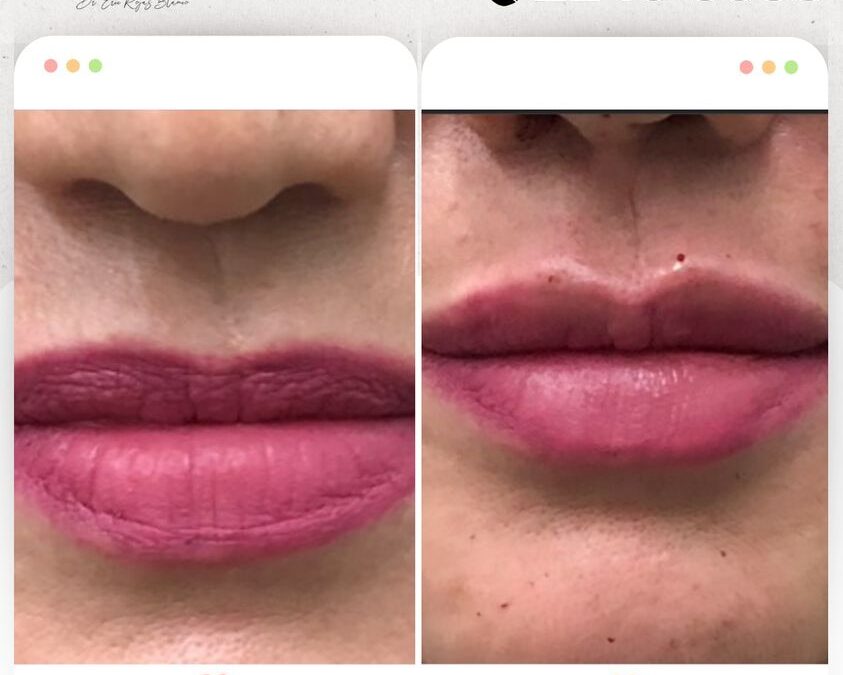 Relleno de labios en $400 dólares, no esperes más.