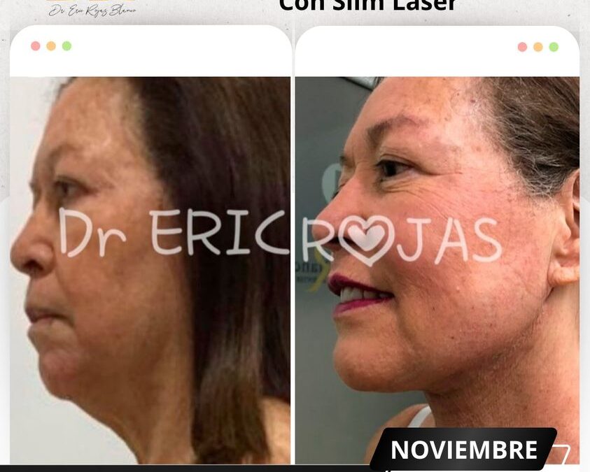 Mira los increíbles resultados del Slim Láser en papada, ¿Qué te pareció el cambio?, no esperes más.