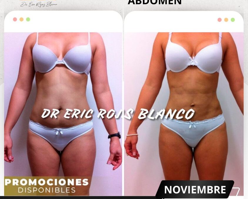 ¡Aún tienes tiempo!, aprovecha los descuentos en Slim Láser