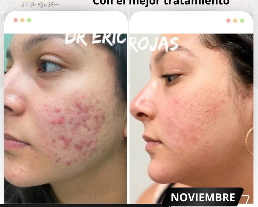 Elimina el acné de una vez por todas.