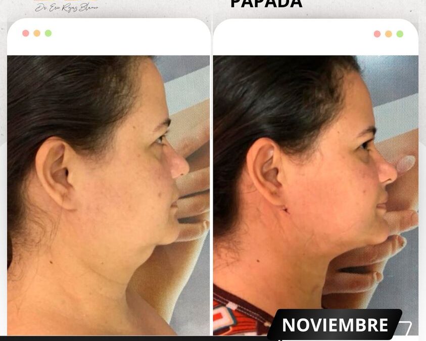 Slim Láser papada, resultados asombrosos.