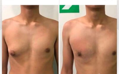 Mira los increíbles resultados del Slim Láser en nuestro paciente, ¿Qué te pareció el cambio?