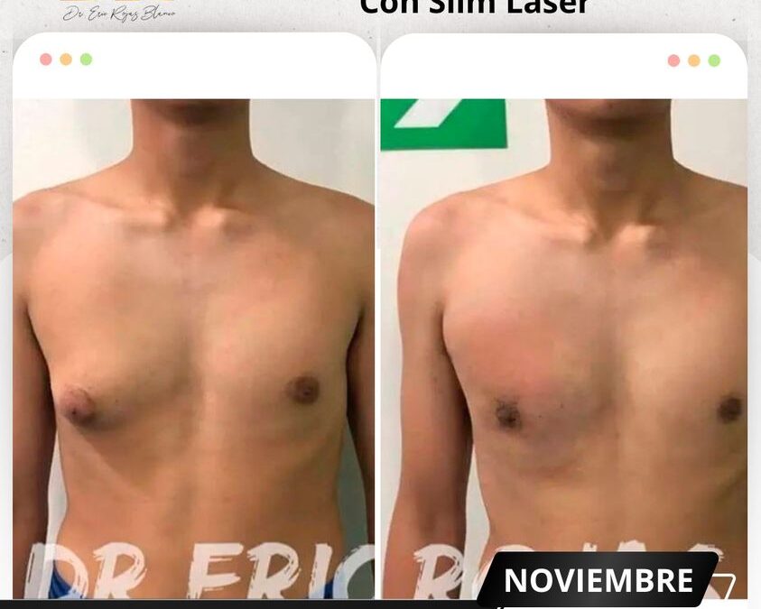 Mira los increíbles resultados del Slim Láser en nuestro paciente, ¿Qué te pareció el cambio?