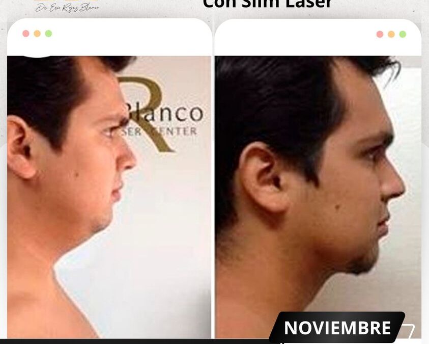 Mira los increíbles resultados del Slim Láser en papada, ¿Qué te pareció el cambio?