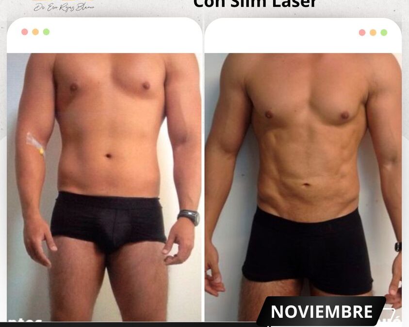 Mira los increíbles resultados del Slim Láser en nuestro paciente, ¿Qué te pareció el cambio?