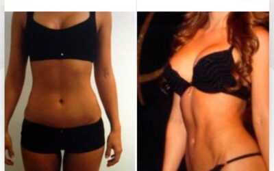 Mira los increíbles resultados del Slim Láser abdomen, ¿Qué te pareció el cambio?