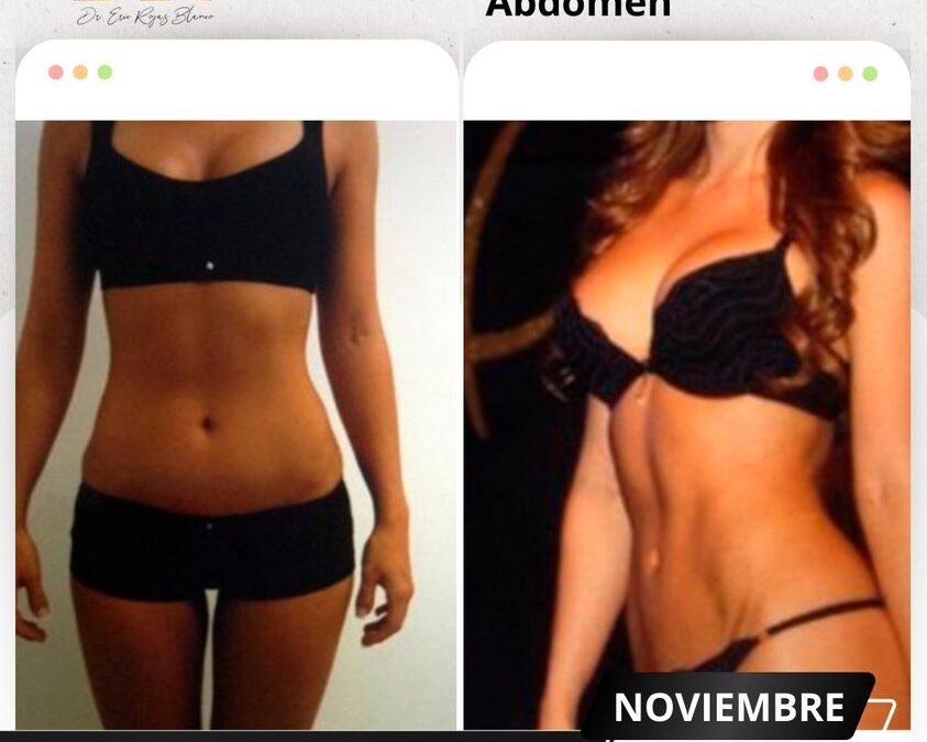 Mira los increíbles resultados del Slim Láser abdomen, ¿Qué te pareció el cambio?