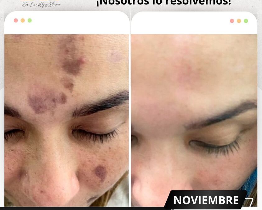 Limpia tu rostro con nuestros tratamientos, ¿Qué te pareció el cambio? 👇