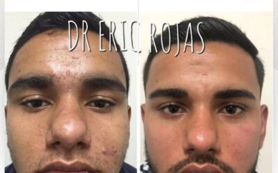 Tenemos la solución para limpiar tu rostro, el mejor tratamiento del país.