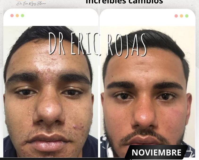 Tenemos la solución para limpiar tu rostro, el mejor tratamiento del país.