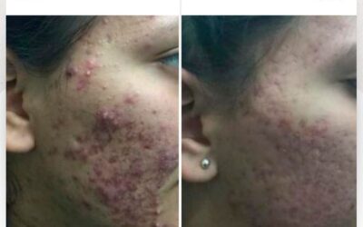 Elimina el acné con nuestro increíble tratamiento.