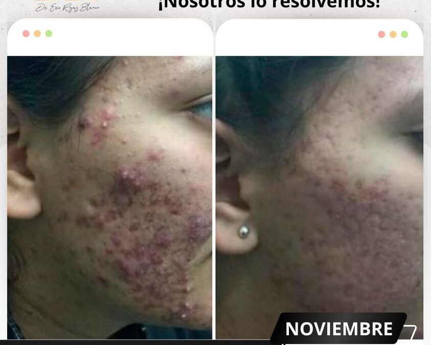 Elimina el acné con nuestro increíble tratamiento.