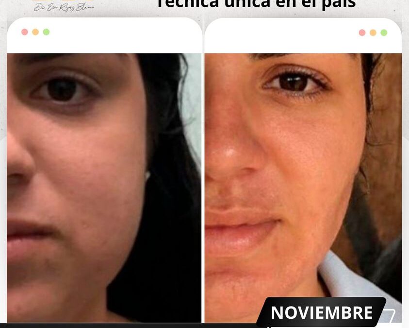 Mira el antes y después de nuestro procedimiento de bichectomía Láser en nuestro paciente.
