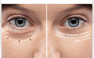 Rejuvenece tu mirada con la Blefaroplastía