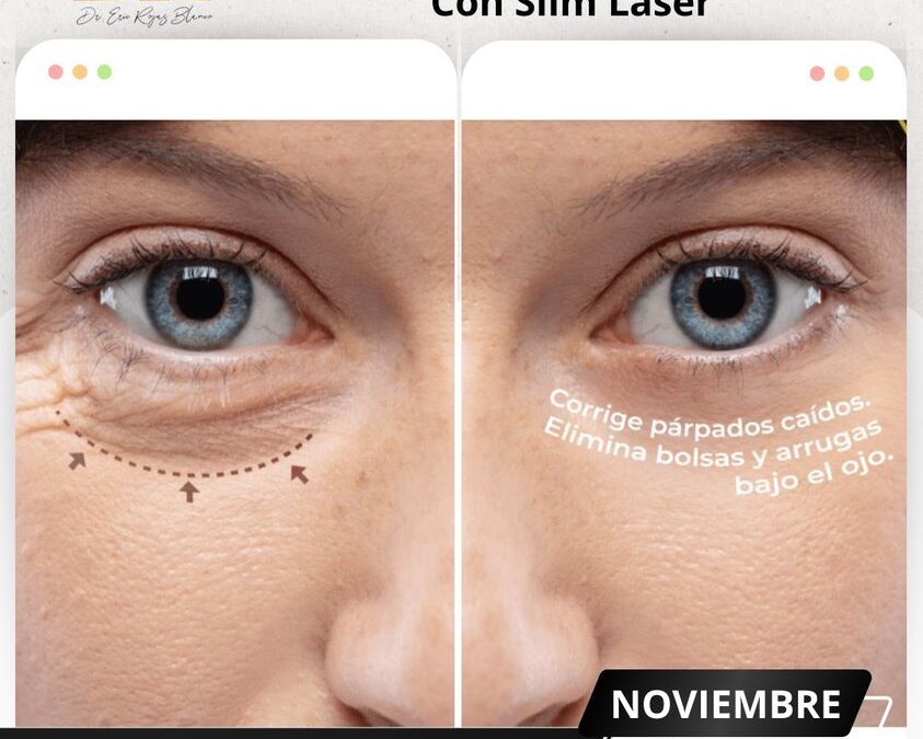 Rejuvenece tu mirada con la Blefaroplastía