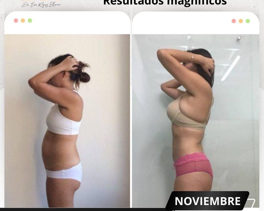 Slim Láser, increíbles cambios en tu cuerpo.