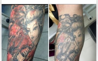 ¿Tienes problemas de piel por tus tatuajes?, te podemos ayudar.
