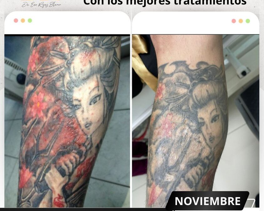 ¿Tienes problemas de piel por tus tatuajes?, te podemos ayudar.