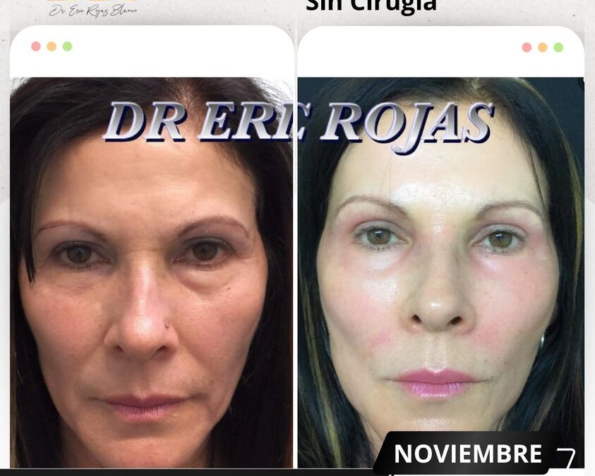 Rejuvenecimiento sin cirugía, increíble procedimiento.