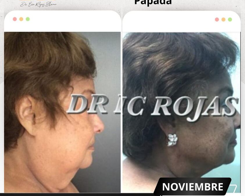 Increíble cambio con Slim Láser papada.