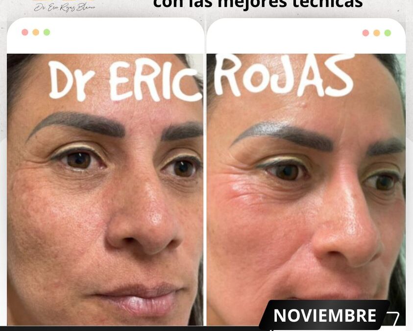 Rejuvenece tu rostro, contamos con el mejor tratamiento.