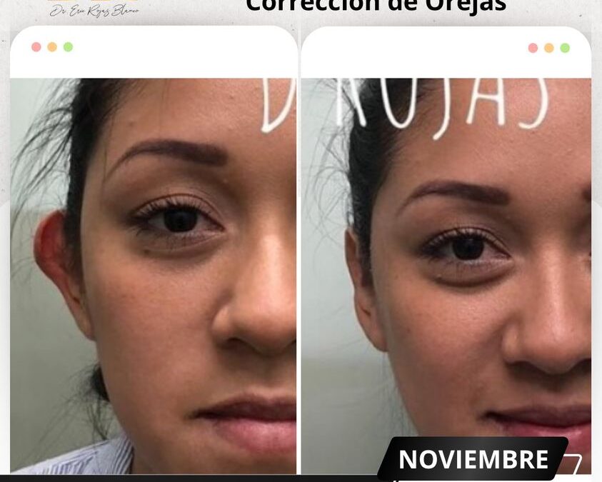 Dermo – Otoplastía, el procedimiento que corrige tus orejas en 15 minutos.