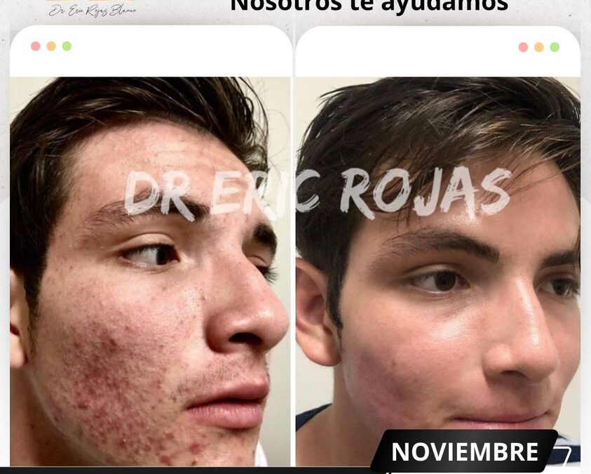 Tratamiento contra el acné.