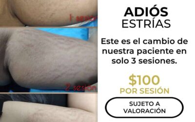 Elimina las estrías con nuestro increíble láser.