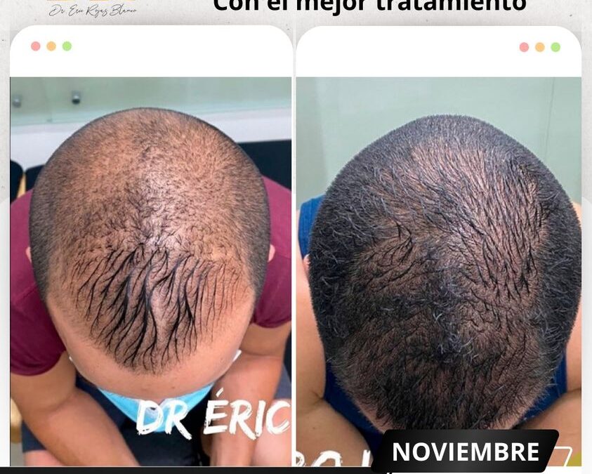 Detén la caída de cabello, en solo dos meses miras resultados.