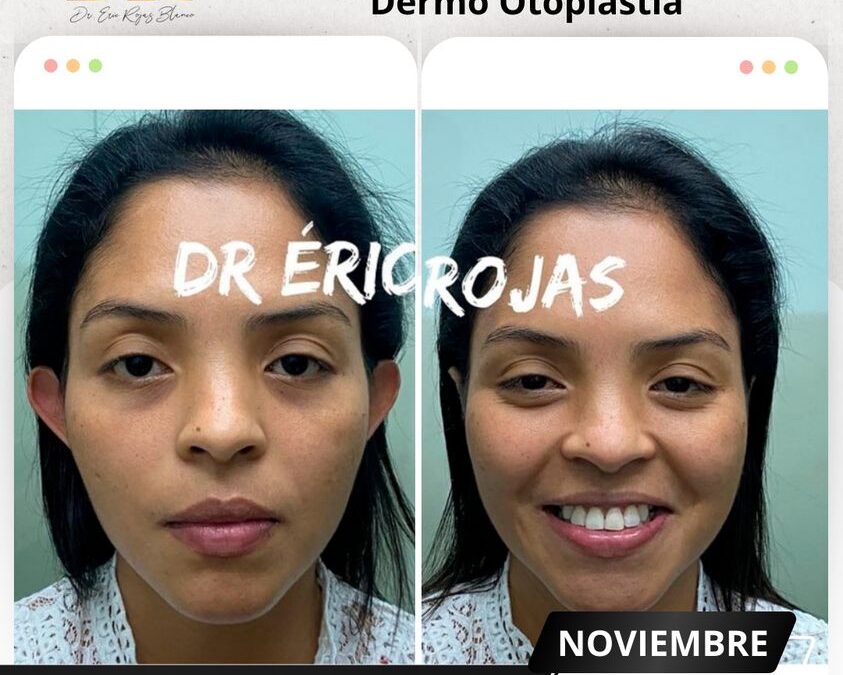 Corrección de orejas con la mejor técnica.👇😉