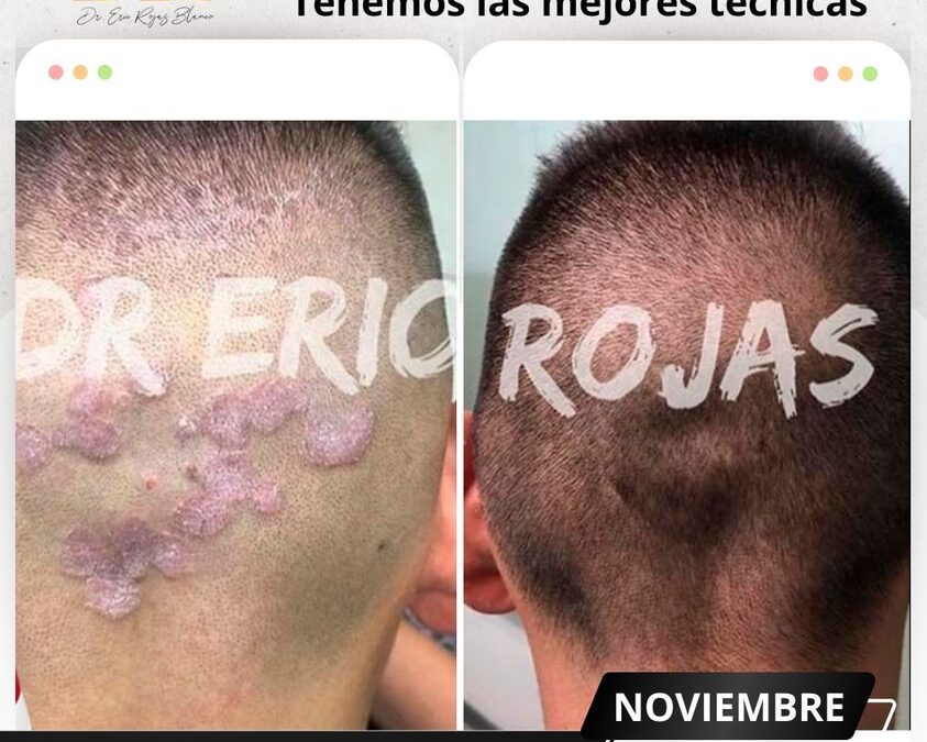 Elimina los hongos de tu piel. 🆒👇