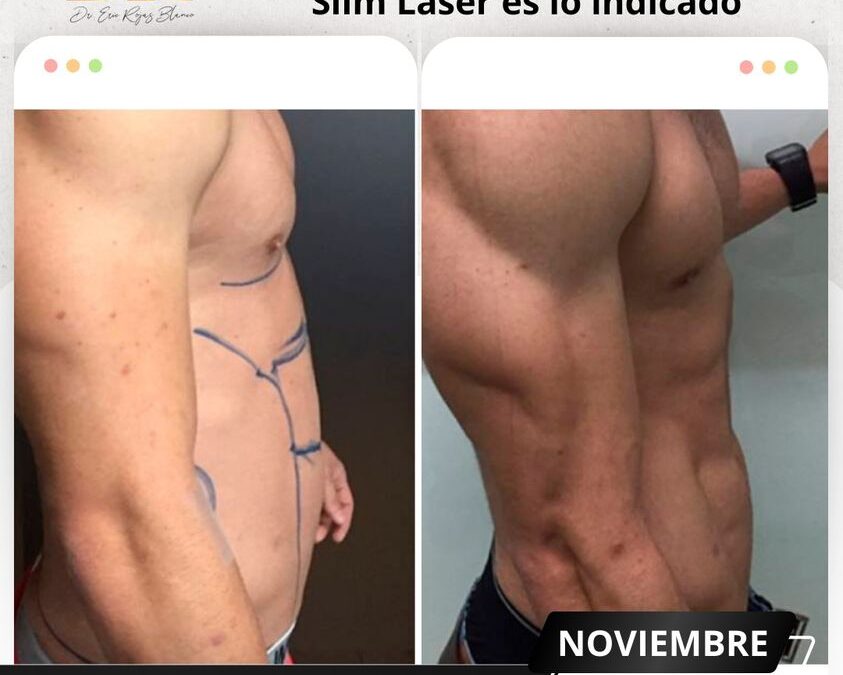 Marcaje con Slim Láser.