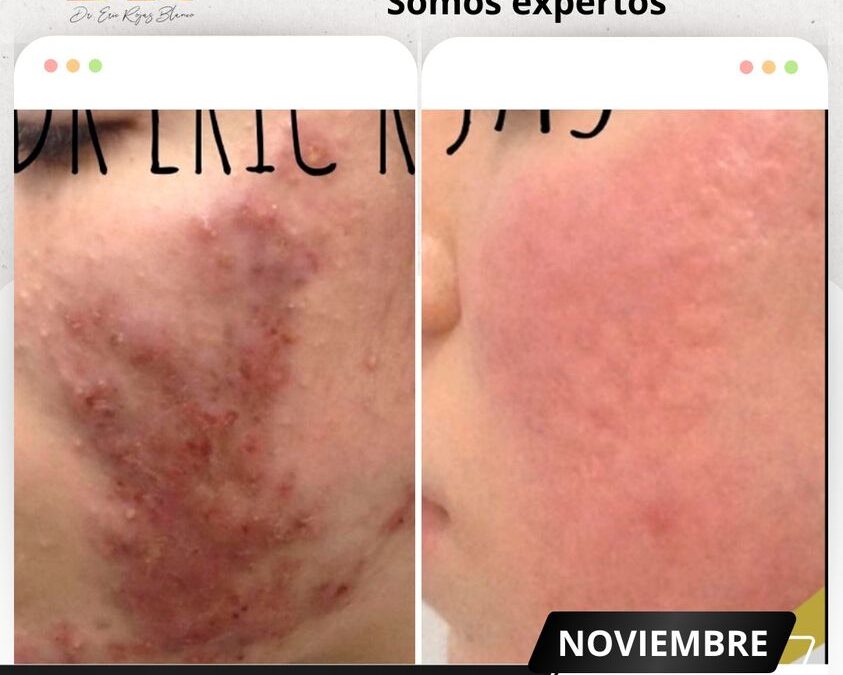 Un rostro limpio, con nuestro tratamiento es posible
