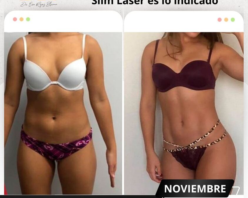 Slim láser, el mejor procedimiento.