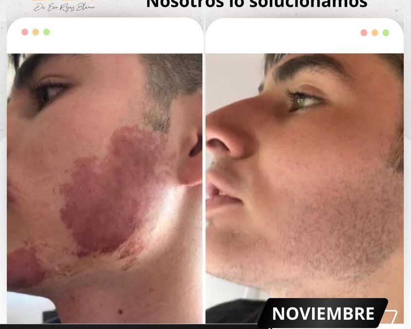 Solucionamos las manchas de tu rostro con el mejor tratamiento. 📞Agenda tu cita ahora: +506 2248-3535