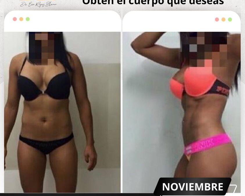 Slim Láser te brindará el cuerpo que deseas.👇😉