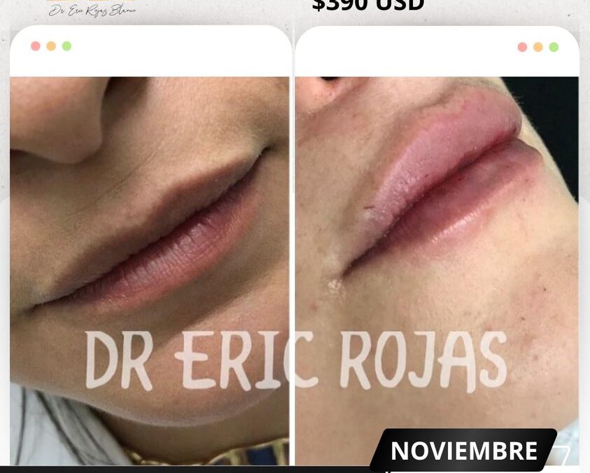 Relleno y moldeo de labios.👇😉