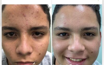 Adiós al acné con nuestro tratamiento
