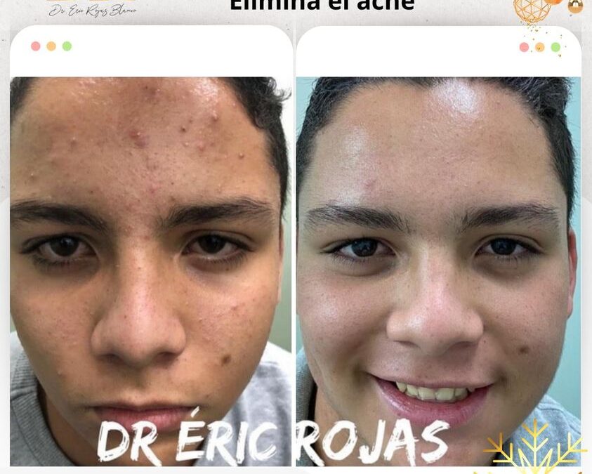 Adiós al acné con nuestro tratamiento