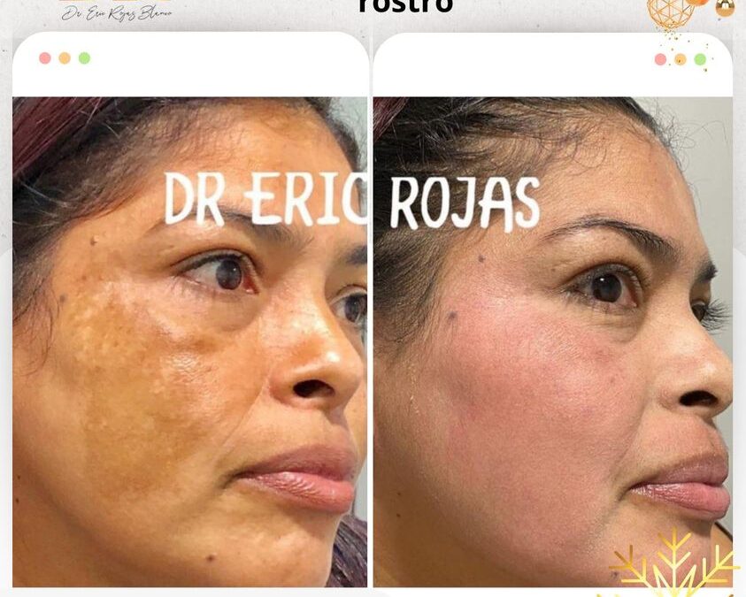 Elimina las manchas de tu rostro con el tratamiento único
